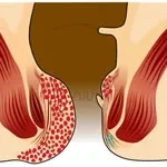 obat ambeien - obat ambeien ampuh - obat ambeien paling ampuh - obat ambeien stadium 4 - obat ambeien untuk ibu hamil - obat ambeien berdarah - obat nyeri ambeien